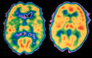brain-scan